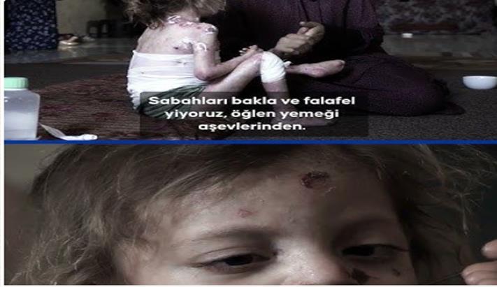 Gazze’de Kelebek Hastası Minik Nur, Yaşam Mücadelesi Veriyor